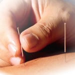 Poate ajuta acupunctura la tratarea migrenelor?